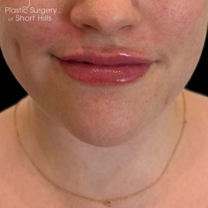 Lip Filler Before & After Patient #16752