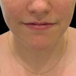 Lip Filler Before & After Patient #16752