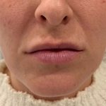 Lip Filler Before & After Patient #16759