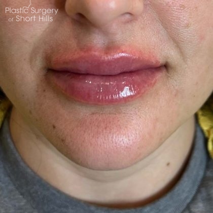 Lip Filler Before & After Patient #16753