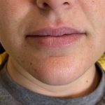 Lip Filler Before & After Patient #16753