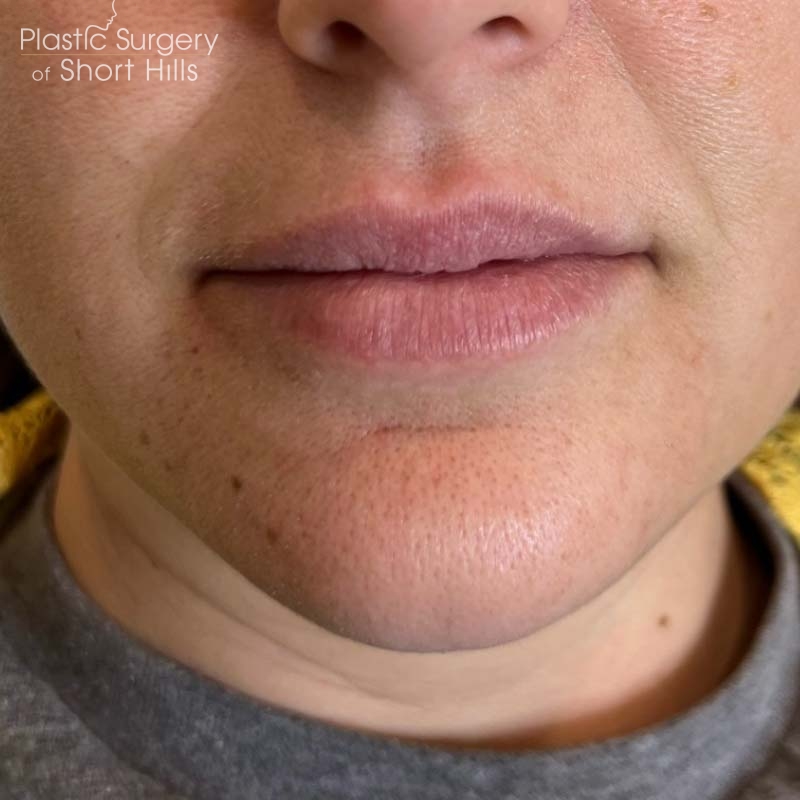 Lip Filler Before & After Patient #16753