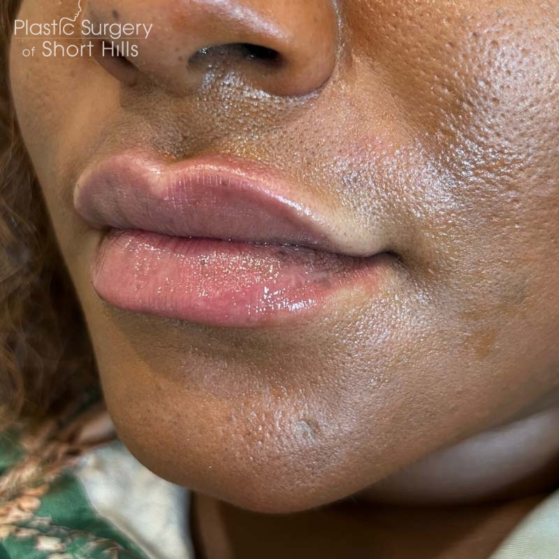 Lip Filler Before & After Patient #16754