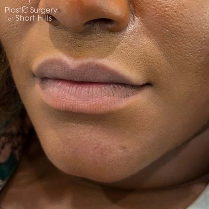 Lip Filler Before & After Patient #16754