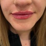 Lip Filler Before & After Patient #16755