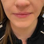 Lip Filler Before & After Patient #16755