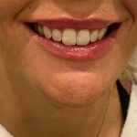 Lip Filler Before & After Patient #16756