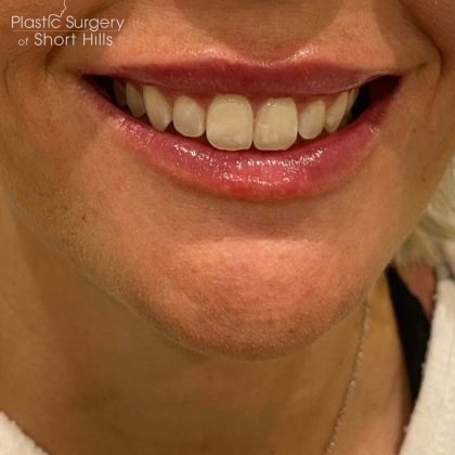 Lip Filler Before & After Patient #16756