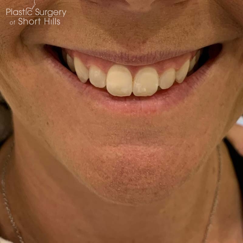 Lip Filler Before & After Patient #16756