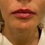 Lip Filler Before & After Patient #16757