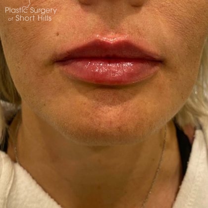 Lip Filler Before & After Patient #16757