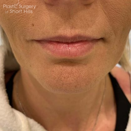 Lip Filler Before & After Patient #16757