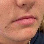 Lip Filler Before & After Patient #16758