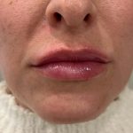 Lip Filler Before & After Patient #16759