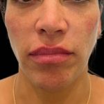 Lip Filler Before & After Patient #16760