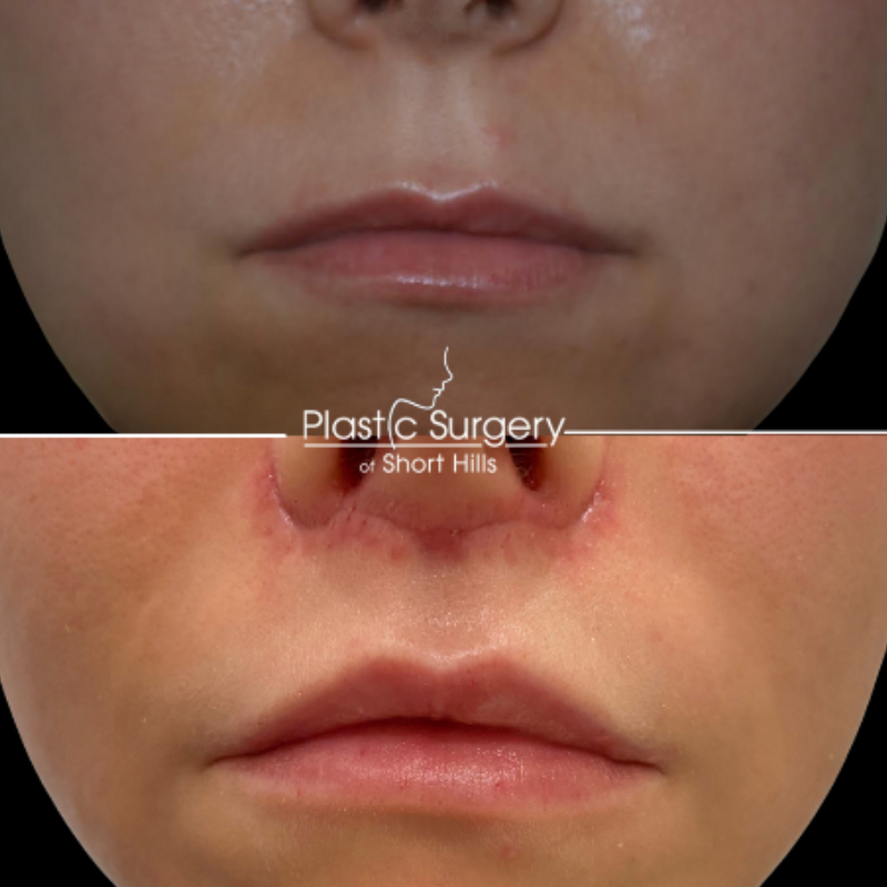 What Is A Surgical Lip Lift Infoupdate