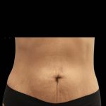 TruSculpt 3D Before & After Patient #16761