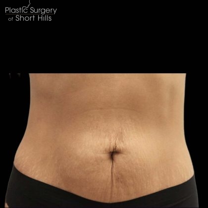 TruSculpt 3D Before & After Patient #16761