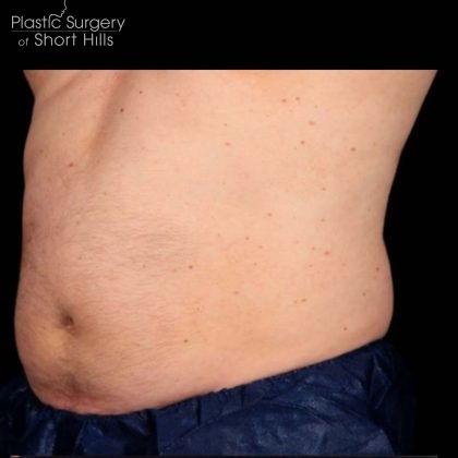 TruSculpt 3D Before & After Patient #16768