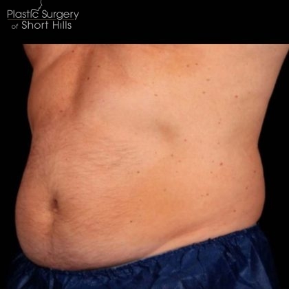 TruSculpt 3D Before & After Patient #16768