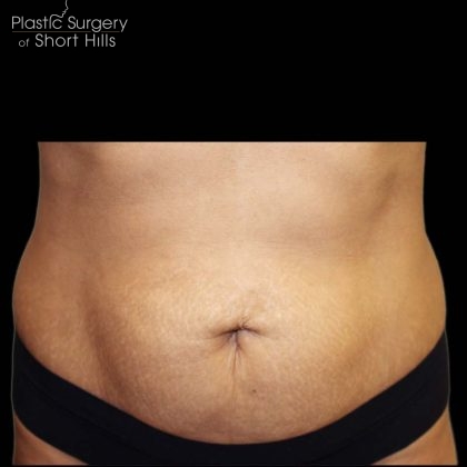 TruSculpt 3D Before & After Patient #16761