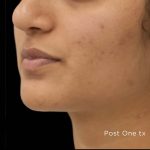 TruSculpt 3D Before & After Patient #16769