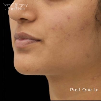 TruSculpt 3D Before & After Patient #16769