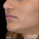 TruSculpt 3D Before & After Patient #16769