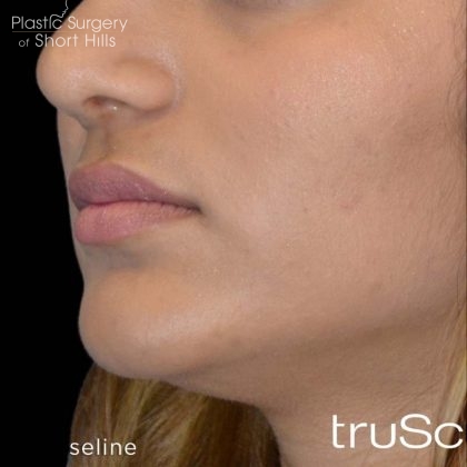 TruSculpt 3D Before & After Patient #16769