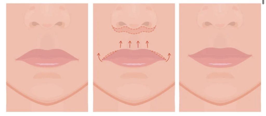 Lip Lift in Short Hills