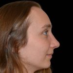 Rhinoplasty Before & After Patient #16906