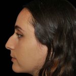 Rhinoplasty Before & After Patient #16918