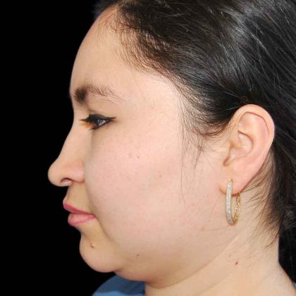 Rhinoplasty Before & After Patient #16931