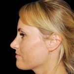 Rhinoplasty Before & After Patient #17049