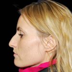 Rhinoplasty Before & After Patient #17049