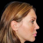 Rhinoplasty Before & After Patient #16939