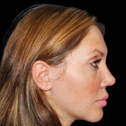 Rhinoplasty Before & After Patient #16939