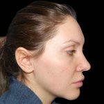 Rhinoplasty Before & After Patient #16939