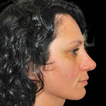 Rhinoplasty Before & After Patient #16946