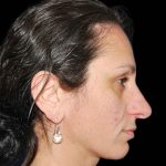 Rhinoplasty Before & After Patient #16946