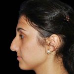 Rhinoplasty Before & After Patient #16953