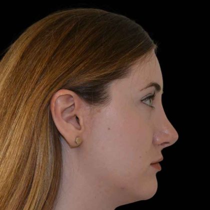 Rhinoplasty Before & After Patient #16960