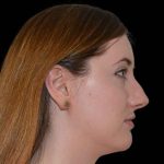 Rhinoplasty Before & After Patient #16960