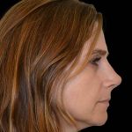 Rhinoplasty Before & After Patient #16967