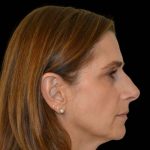 Rhinoplasty Before & After Patient #16967