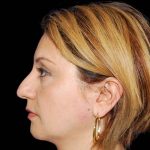 Rhinoplasty Before & After Patient #17039