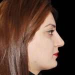 Rhinoplasty Before & After Patient #16974