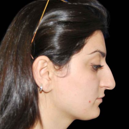 Rhinoplasty Before & After Patient #16974