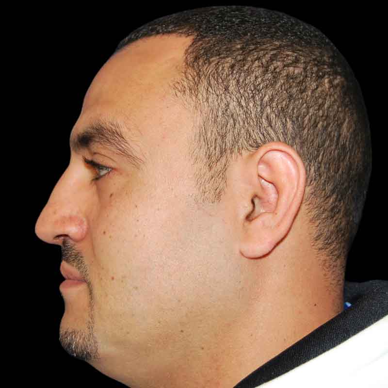 Rhinoplasty Before & After Patient #16981