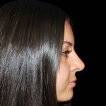 Rhinoplasty Before & After Patient #16988